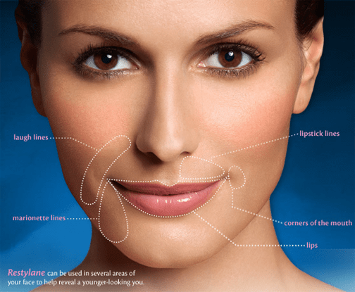 Augmentare buze cu acid hialuronic Restylane în Iași