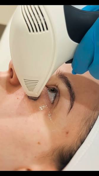 Viora V-FR facial Iași tratament cu radiofrecvență fracționată