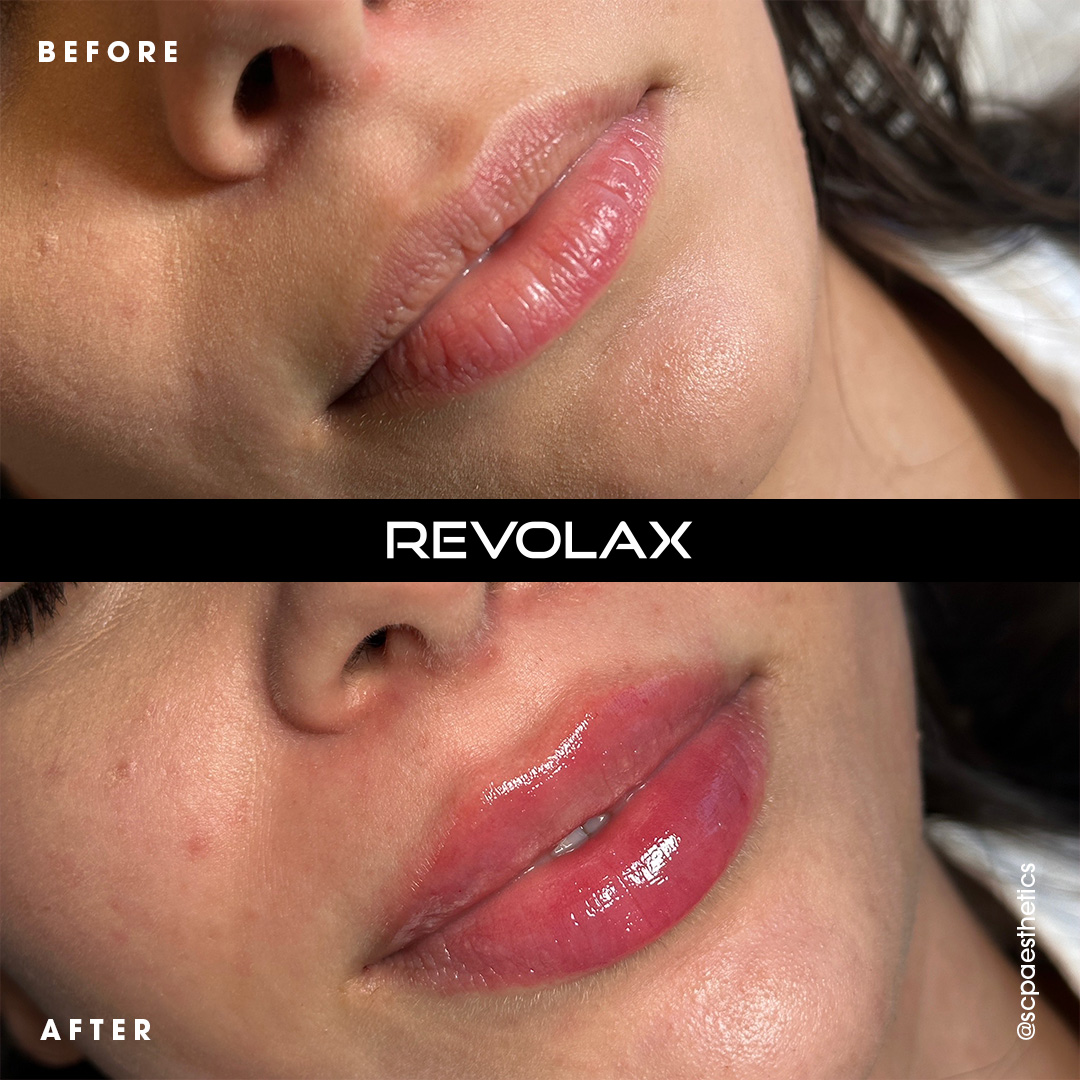 Mărire buze cu acid hialuronic Revolax în Iași